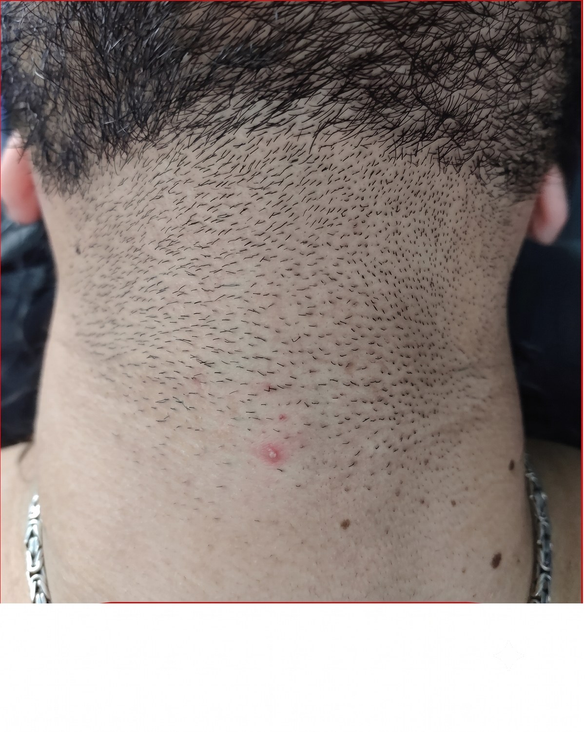 Linha da barba antes — antes do tratamento