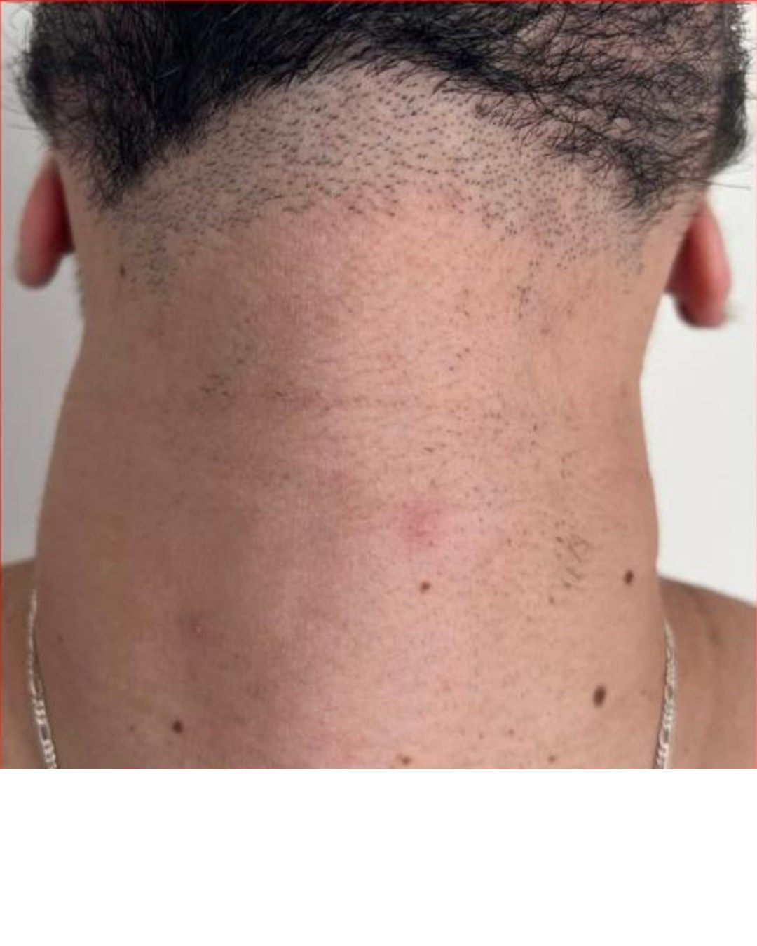 Linha da barba depois — após 5 sessões