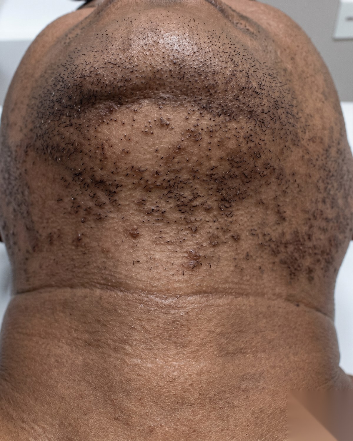 Linha da barba paciente B antes