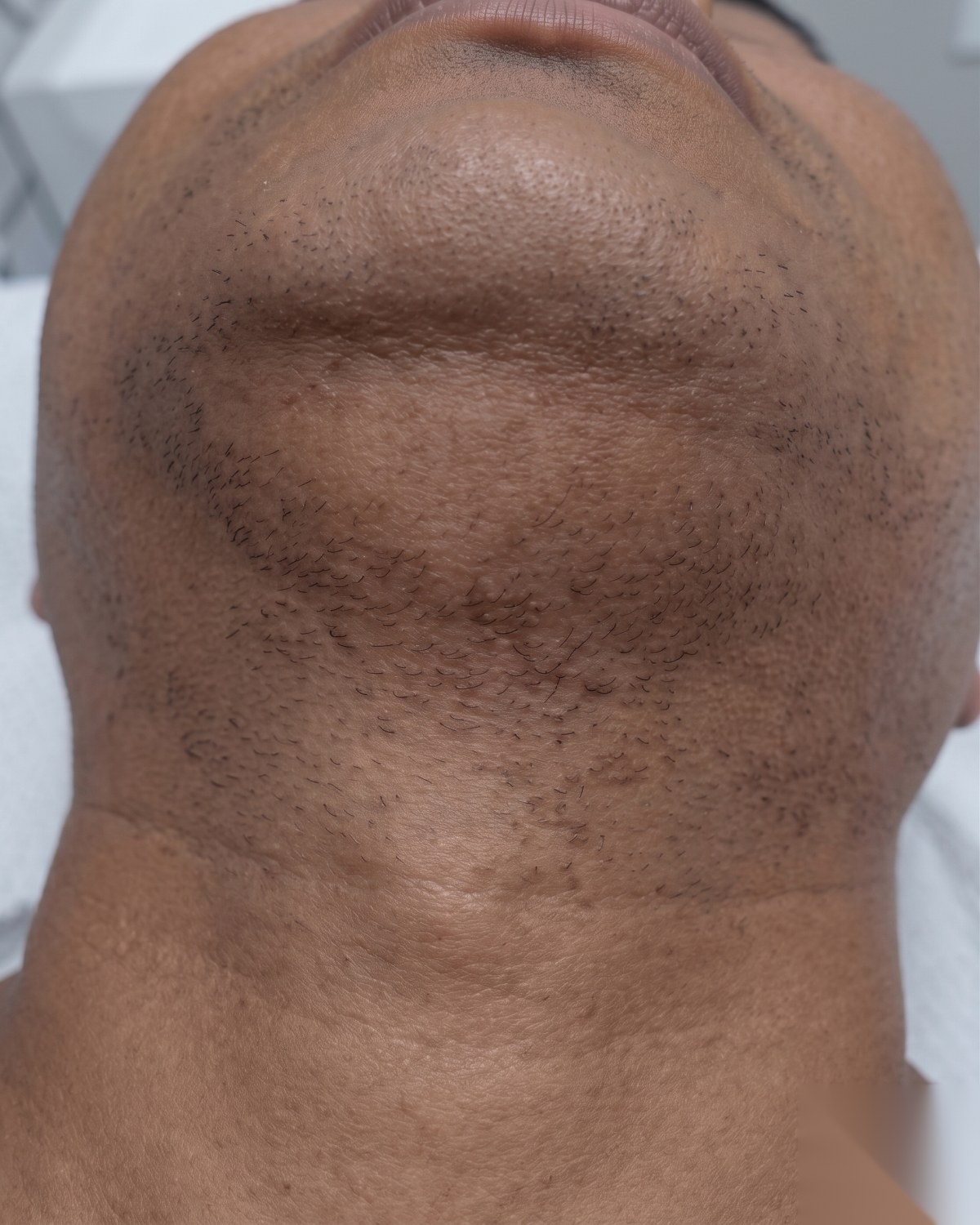 Linha da barba paciente B depois