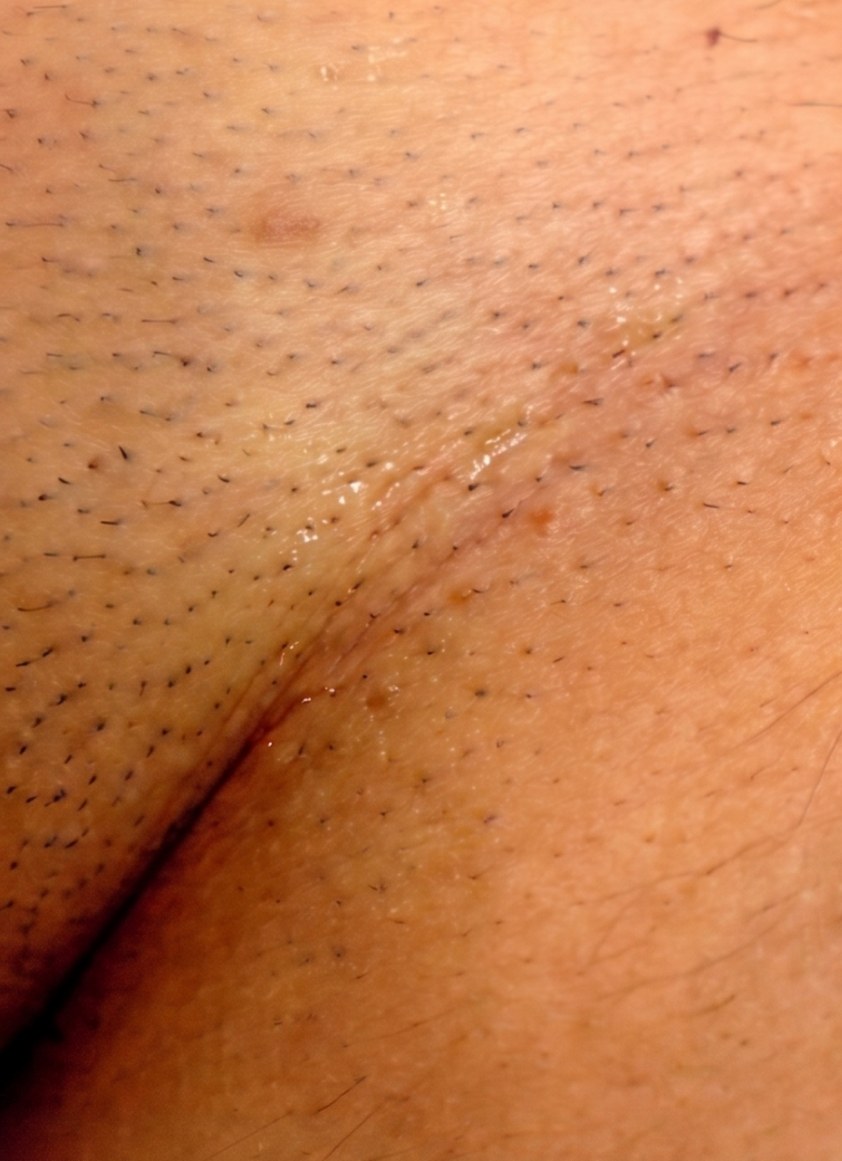 Virilha feminina antes — depilação definitiva