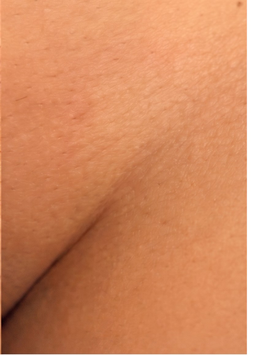 Virilha feminina depois — depilação definitiva